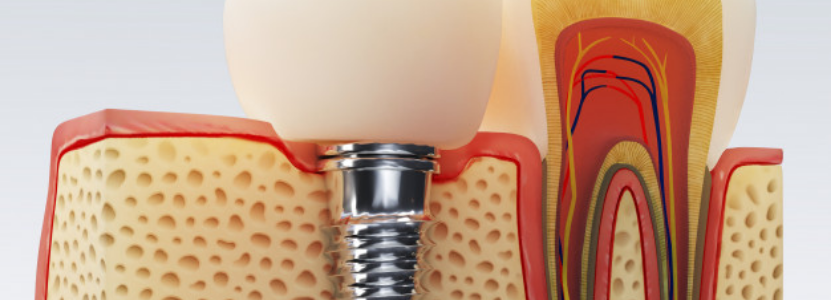 Step by step guide to root canal treatment