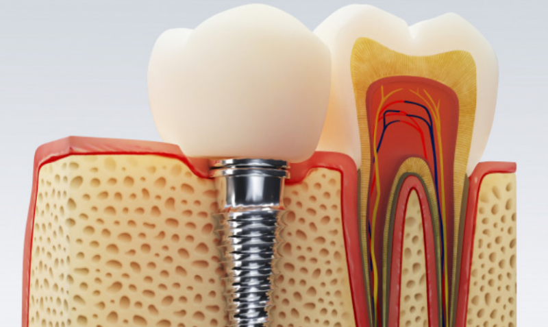Step by step guide to root canal treatment